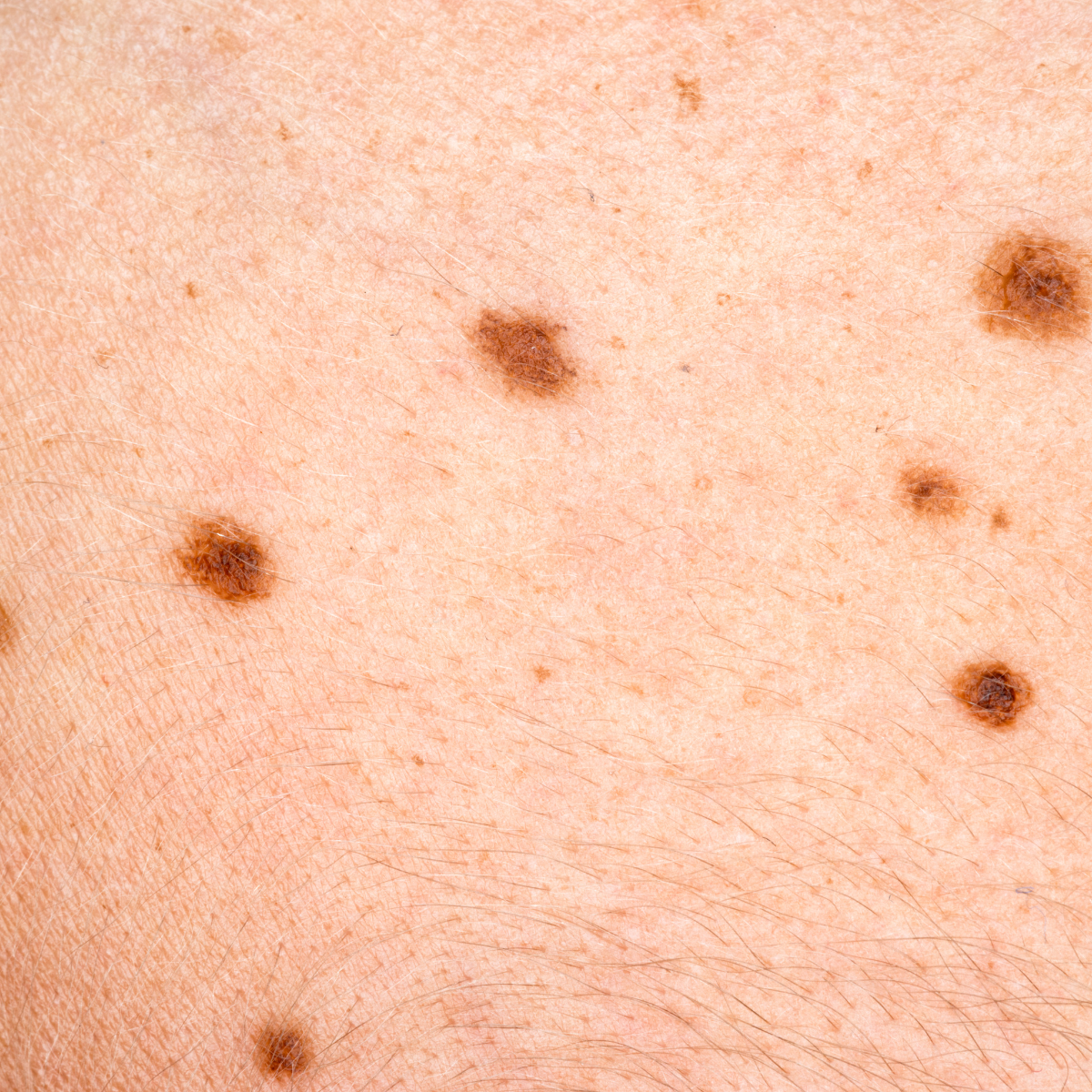 Melanoma - Skin Cancer